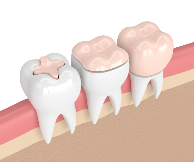 reconstruccions dentals